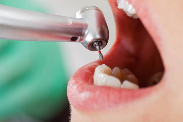 Best Emergency Root Canal Treatment in Canton, SD